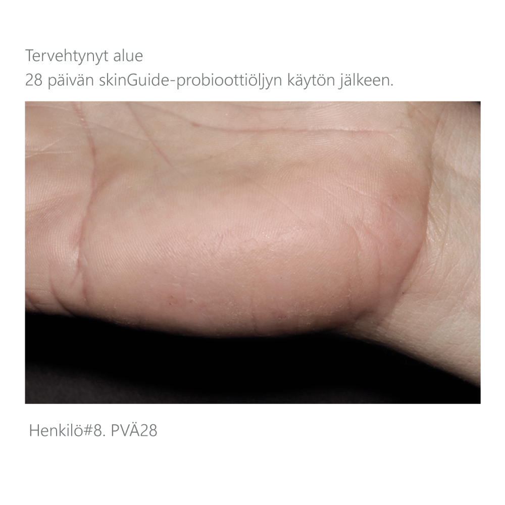 Käden-terve-iho-skinGuide-probioottiöljyn-käytön-jälkeen
